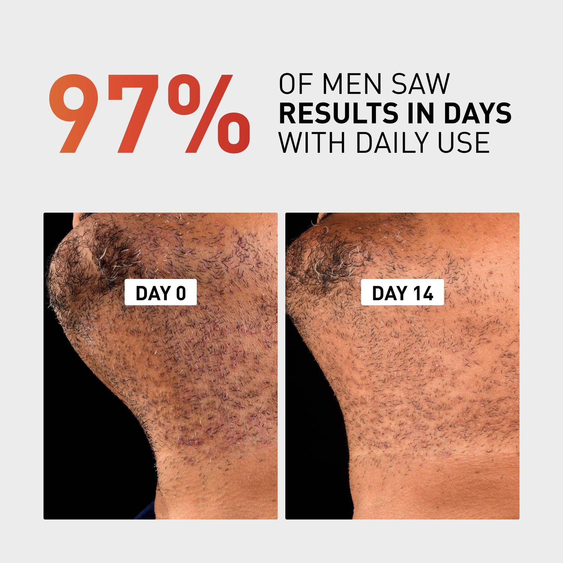Over 97% of men saw results in days with daily use of Frederick Benjamin Grooming's Bump Clear razor bump cream.